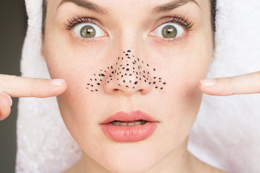 5 Ways To Get Rid Of Blackheads